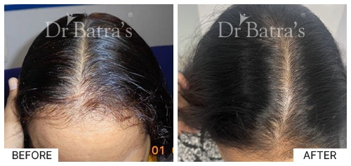 Hair Falling Treatment